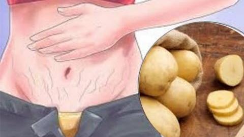 Como acabar com as estrias rapidamente usando batatas