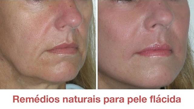 Como acabar com a flacidez da pele do rosto com estes 5 remédios naturais