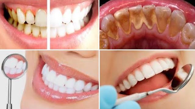 Misture 2 ingredientes e Passe nos Dentes – Veja o Resultado